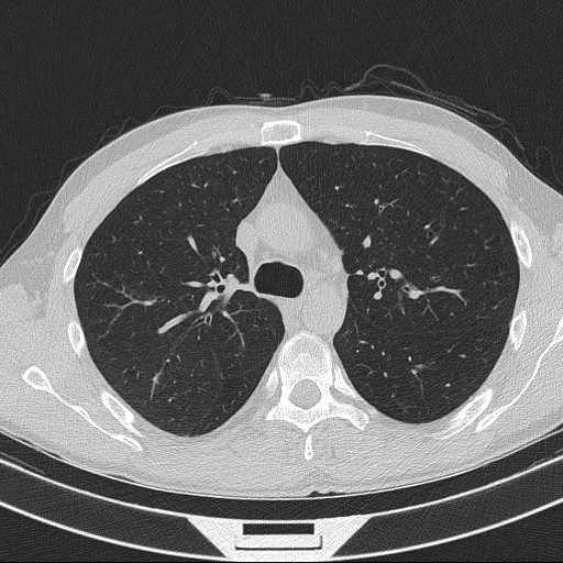 Bronchocele (Radiopaedia 60676-68429 Axial lung window 24).jpg