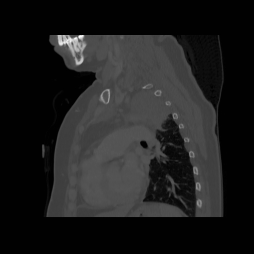 Bronchogenic carcinoma (Radiopaedia 73497-84262 Sagittal bone window 100).jpg