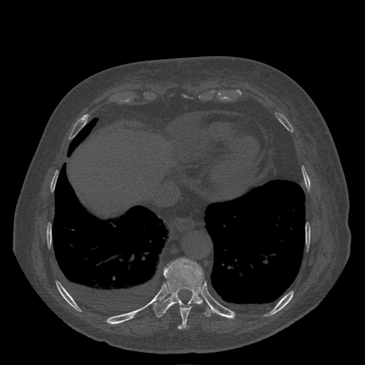 Bronchogenic carcinoma with metastatic lymphadenopathy (Radiopaedia 37671-39569 Axial bone window 43).jpg