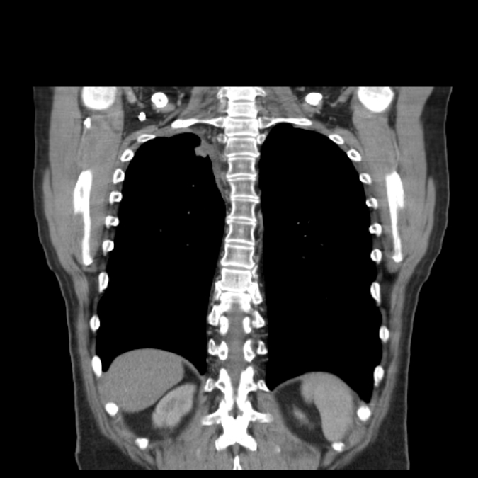 Bronchogenic carcinoma with upper lobe collapse (Radiopaedia 29297-29726 D 42).jpg