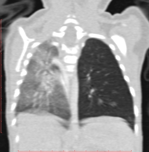 Bronchogenic cyst (Radiopaedia 78599-91409 Coronal lung window 157).jpg