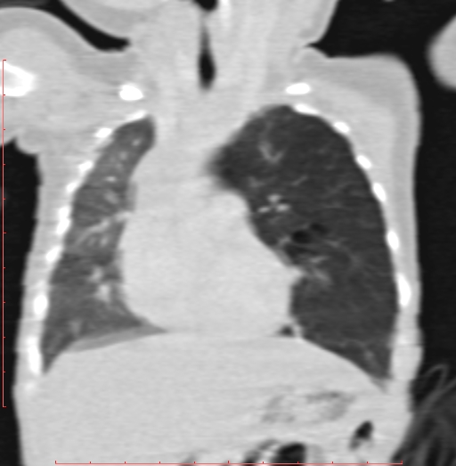 Bronchogenic cyst (Radiopaedia 78599-91409 Coronal lung window 92).jpg