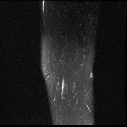 File:Bucket handle meniscus tear (Radiopaedia 56916-63751 Sagittal PD fat sat 20).jpg