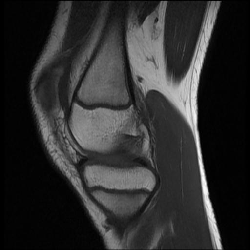 File:Bucket handle tear - lateral meniscus (Radiopaedia 72124-82634 Sagittal T1 11).jpg