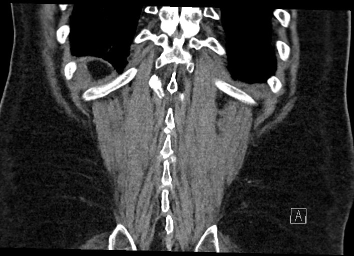 Buried bumper syndrome - gastrostomy tube (Radiopaedia 63843-72577 Coronal Inject 124).jpg