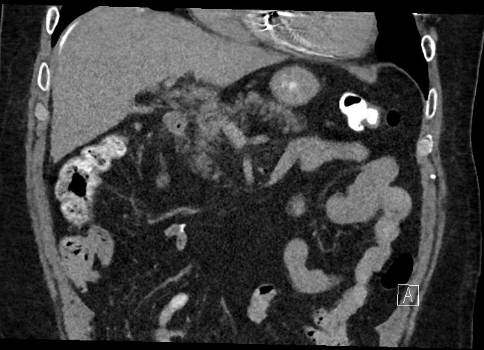 Buried bumper syndrome - gastrostomy tube (Radiopaedia 63843-72577 Coronal Inject 57).jpg