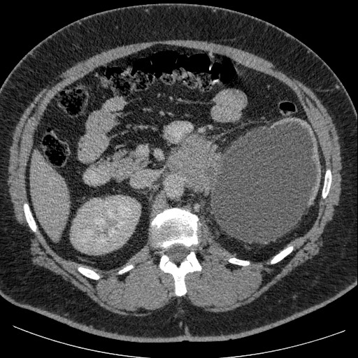 Burned-out testicular seminoma - retroperitoneal nodal metastases (Radiopaedia 62872-71245 A 28).jpg