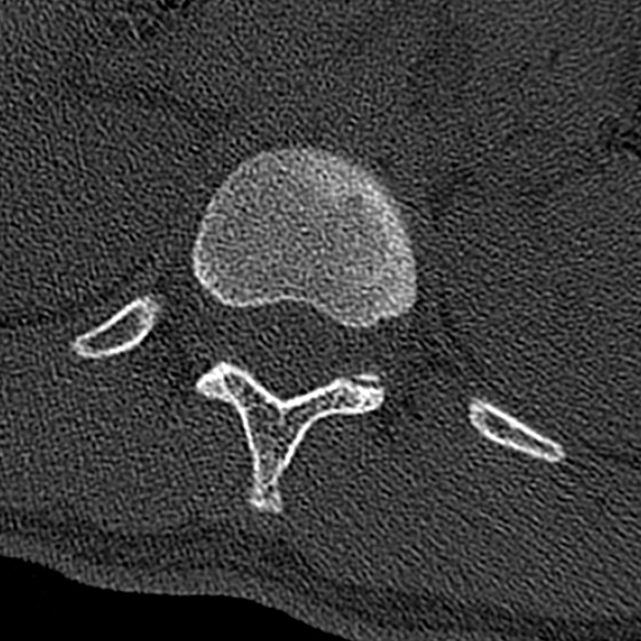 Burst fracture (Radiopaedia 53373-59357 Axial bone window 4).jpg