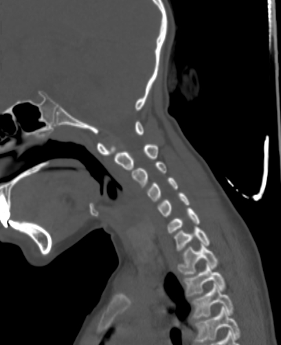 File:Butterfly vertebra (Radiopaedia 77903-90209 Sagittal bone window 30).jpg