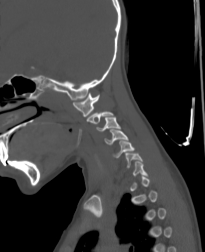 Butterfly vertebra (Radiopaedia 77903-90209 Sagittal bone window 9).jpg