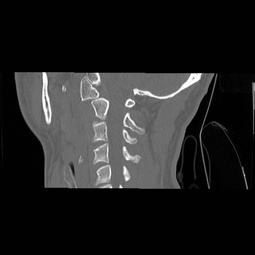 File:C1-C2 "subluxation" - normal cervical anatomy at maximum head rotation (Radiopaedia 42483-45607 C 24).jpg