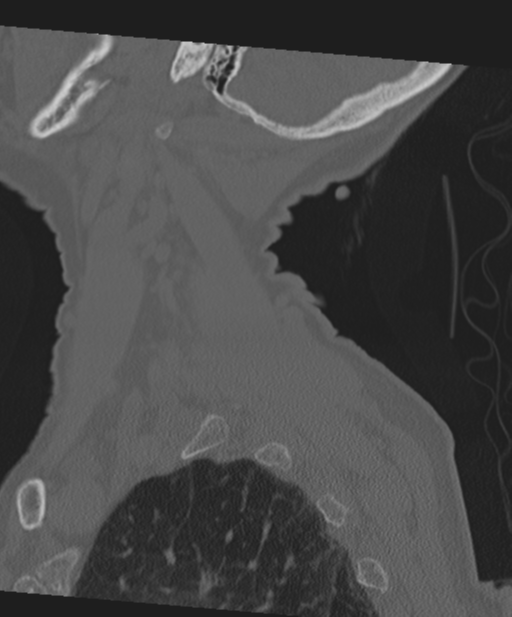 C2 fracture with vertebral artery dissection (Radiopaedia 37378-39199 Sagittal bone window 13).png