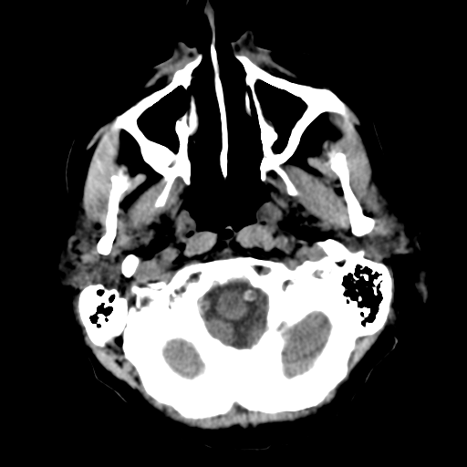 File:CNS lymphoma (Radiopaedia 36983-38639 Axial non-contrast 7).png