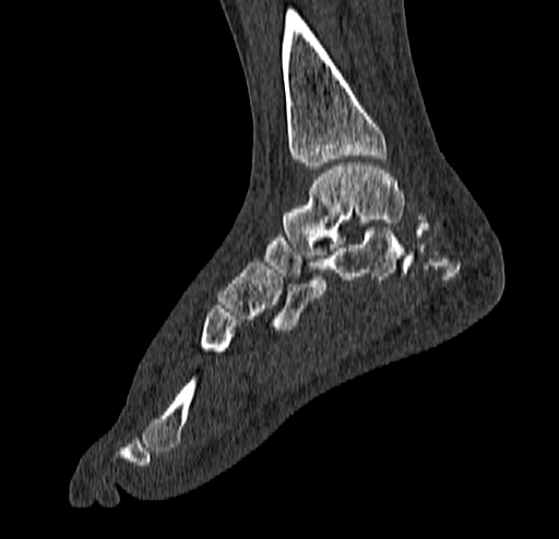 File:Calcaneal fracture - Sanders type 4 (Radiopaedia 90179-107370 Sagittal bone window 49).jpg