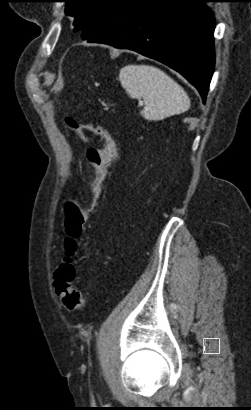 Calcified adrenal glands and Spigelian hernia (Radiopaedia 49741-54988 C 30).jpg