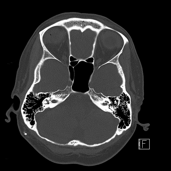 Calcified chronic subdural hematoma (Radiopaedia 77374-89492 Axial bone window 29).jpg
