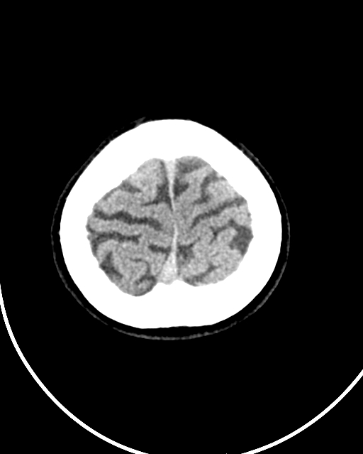 Calcified meningioma (Radiopaedia 74361-85243 Axial non-contrast 6).jpg