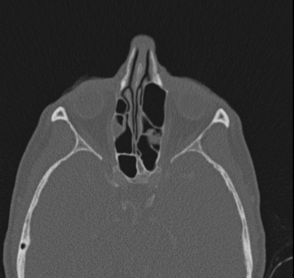 Caldwell-Luc operation (Radiopaedia 52329-58225 Axial bone window 24).jpg