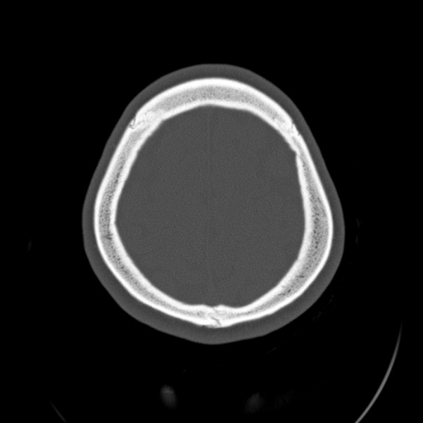 Calvarial osteoma (Radiopaedia 36520-38079 Axial bone window 91).jpg