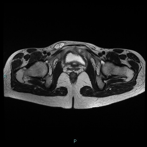 File:Canal of Nuck cyst (Radiopaedia 55074-61448 Axial T2 17).jpg