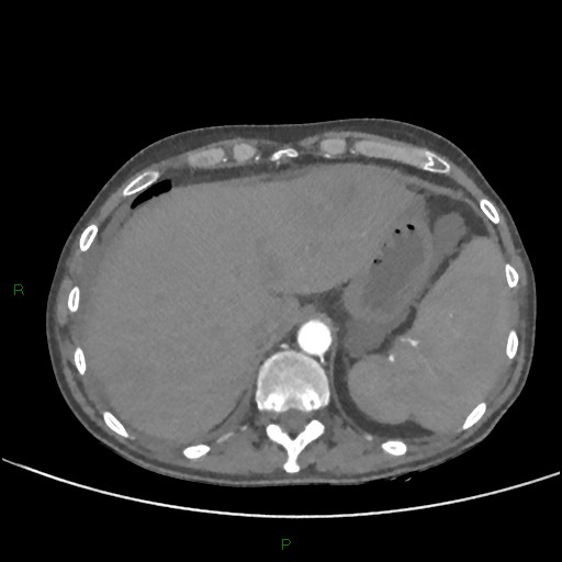 File:Cannonball metastases (Radiopaedia 82110-96150 Axial C+ CTPA 291).jpg