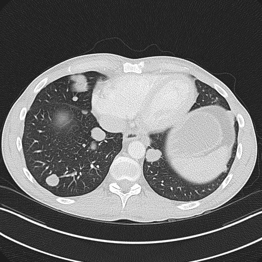 Cannonball metastases - testicular choriocarcinoma (Radiopaedia 84510-99891 Axial lung window 74).jpg