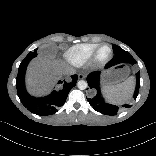 Cannonball metastases - testicular choriocarcinoma (Radiopaedia 84510-99891 B 89).jpg