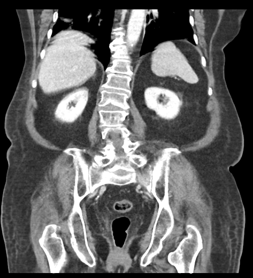 Cannonball metastases from endometrial cancer (Radiopaedia 42003-45031 F 46).png