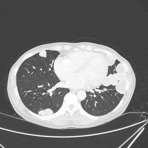 Canonball lung metastasis (Radiopaedia 77634-89837 Axial lung window 117).jpg