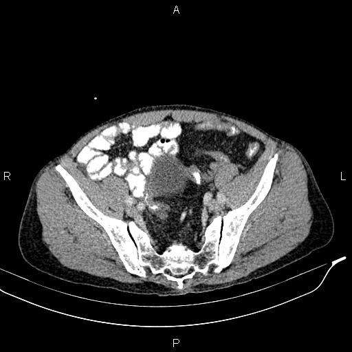 File:Caput medusae sign - portal hypertension (Radiopaedia 64007-72759 A 79).jpg