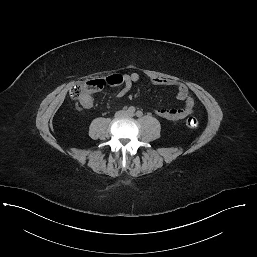 Carcinoid tumor - terminal ileum (Radiopaedia 60931-68740 Axial non-contrast 70).jpg