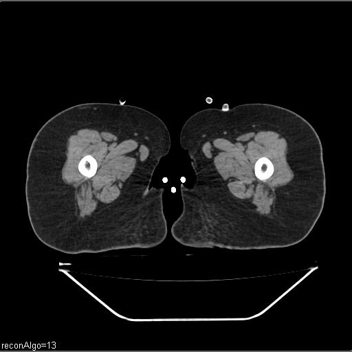 Carcinoma cervix- brachytherapy applicator (Radiopaedia 33135-34173 Axial non-contrast 70).jpg