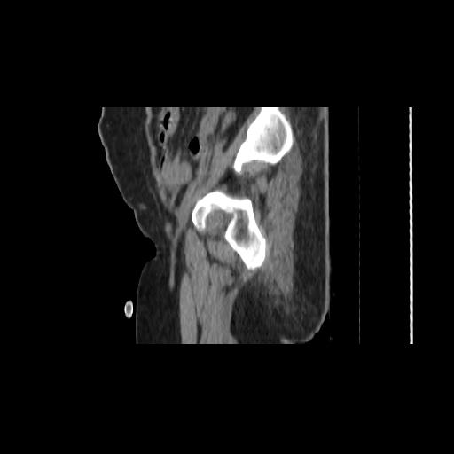 File:Carcinoma cervix- brachytherapy applicator (Radiopaedia 33135-34173 D 26).jpg