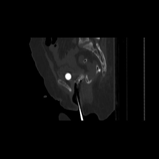 Carcinoma cervix- brachytherapy applicator (Radiopaedia 33135-34173 Sagittal bone window 104).jpg