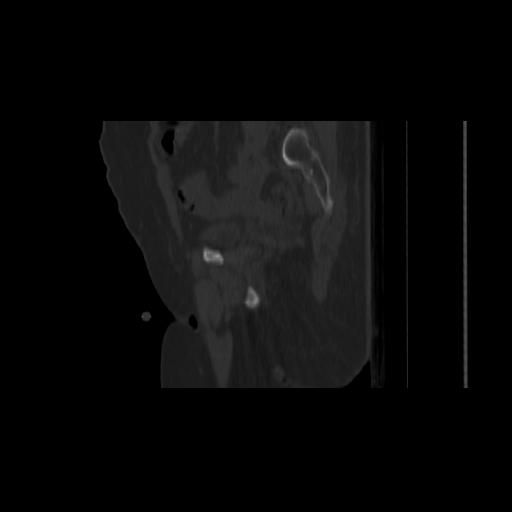 Carcinoma cervix- brachytherapy applicator (Radiopaedia 33135-34173 Sagittal bone window 54).jpg