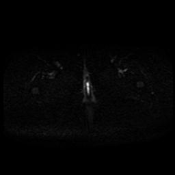 Carcinoma of the cervix (Radiopaedia 89018-105858 Axial DWI 2).jpg