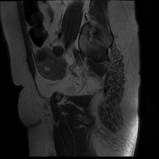 File:Carcinoma of the cervix (Radiopaedia 89018-105858 Sagittal T2 2).jpg