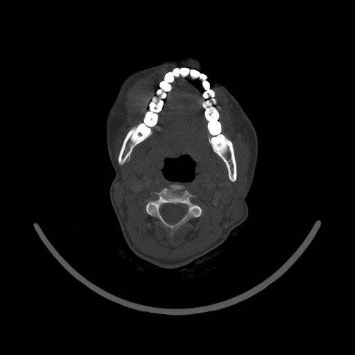 Carcinoma of the maxillary antrum (Radiopaedia 53805-59888 Axial bone window 93).jpg