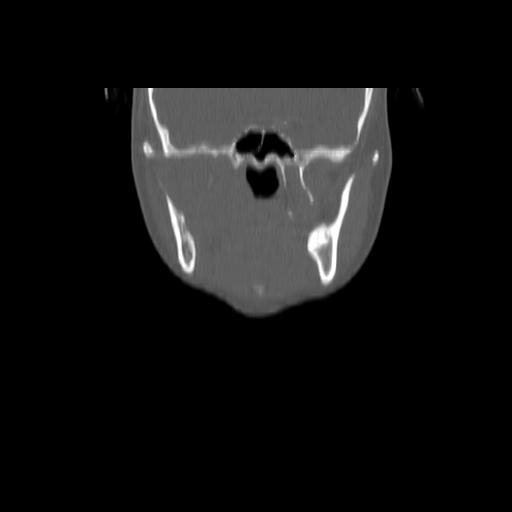 Carcinoma of the maxillary antrum (Radiopaedia 53805-59888 Coronal bone window 63).jpg
