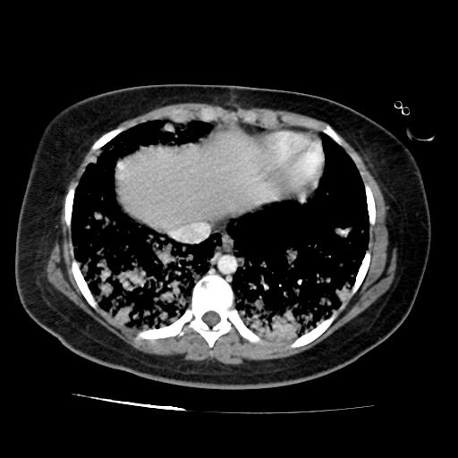 File:Cardiac angiosarcoma (Radiopaedia 66010-75181 B 80).jpg