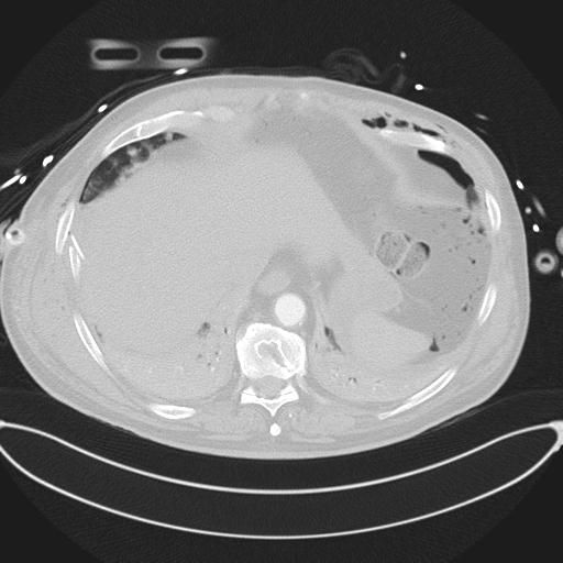 Cardiac trauma (Radiopaedia 32874-33858 Axial lung window 45).jpg