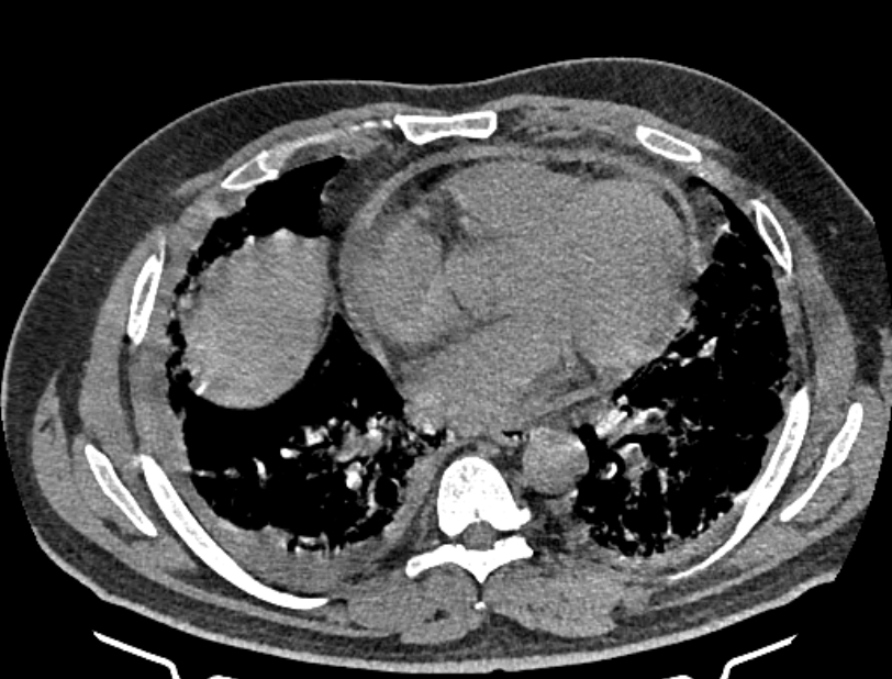 Cardiogenic pulmonary edema (Radiopaedia 68180-77678 Axial non-contrast 31).jpg