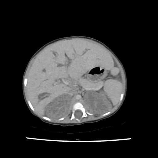 File:Caroli disease with autosomal recessive polycystic kidney disease (ARPKD) (Radiopaedia 89651-106703 B 65).jpg