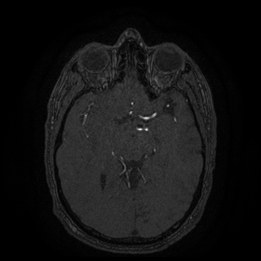 Carotid arterial dissection with acute cerebral infarction (Radiopaedia 26636-26784 MRA 91).jpg