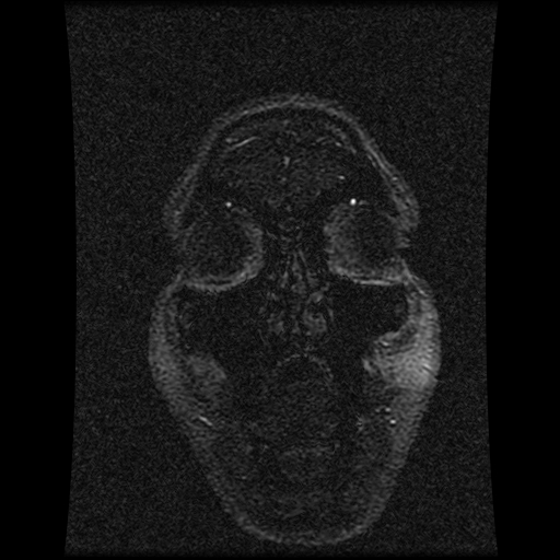 Carotid arterial dissection with acute cerebral infarction (Radiopaedia 26636-26784 MRV 143).jpg
