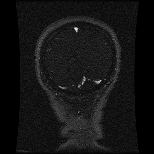 Carotid arterial dissection with acute cerebral infarction (Radiopaedia 26636-26784 MRV 47).jpg
