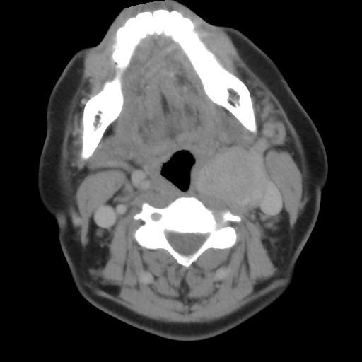 Carotid body tumor (paraganglioma) (Radiopaedia 38586-40729 A 53).jpg