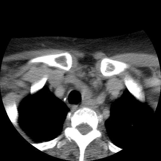 File:Carotid body tumor (paraganglioma) (Radiopaedia 38586-40729 A 67).jpg