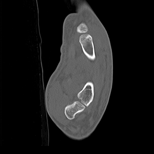 File:Carpo-metacarpal fracture-dislocations with hamatum split fracture (Radiopaedia 18482-18343 Sagittal bone window 24).jpg