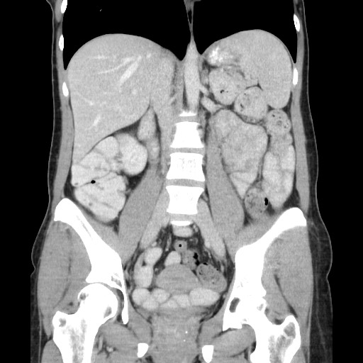 Castleman disease with fibrous pseudotumor in the abdomen (Radiopaedia 77296-89373 B 52).jpg